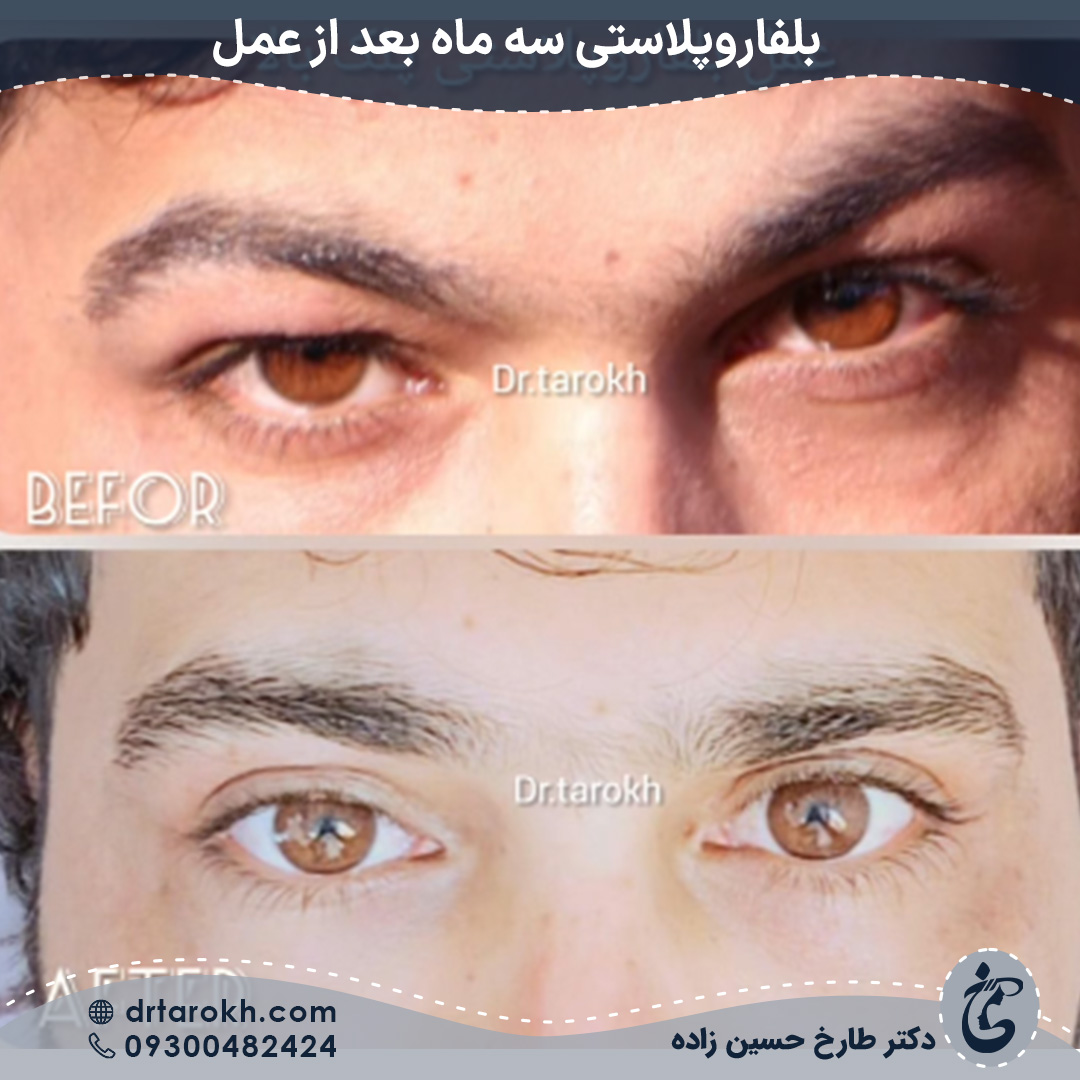 سه ماه بعد از عمل بلفاروپلاستی