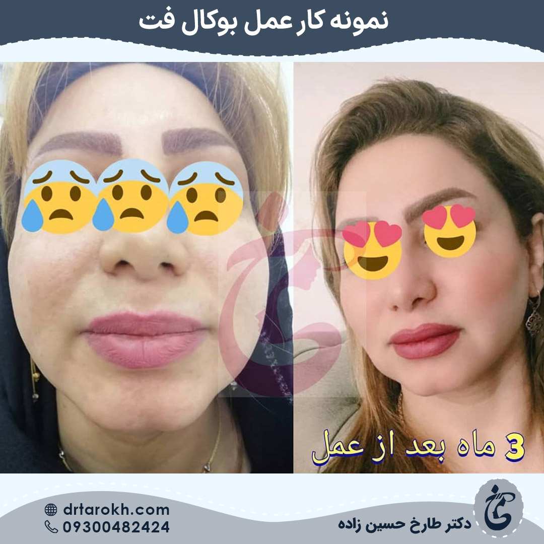 سه ماه بعد از انجام بوکال فت