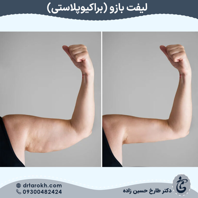 لیفت بازو در شیراز یا براکیوپلاستی