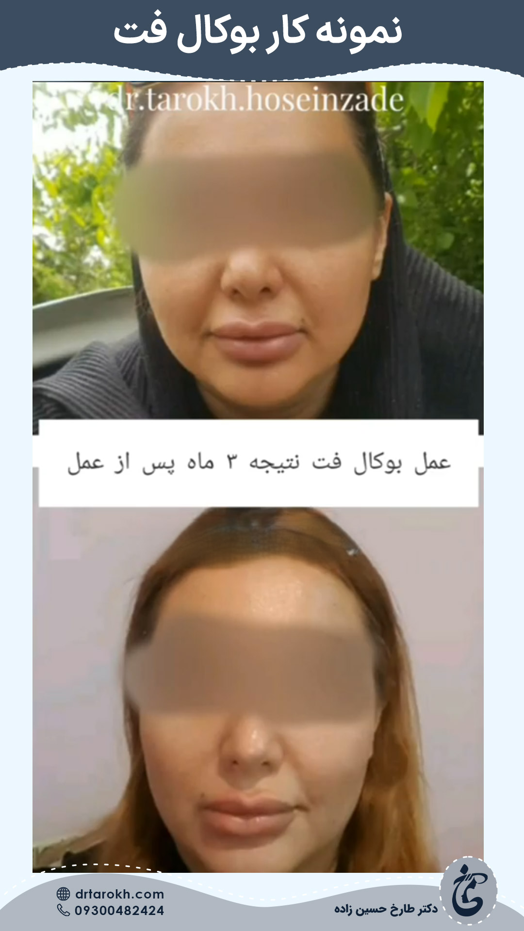 قبل و بعد عمل بوکال فت