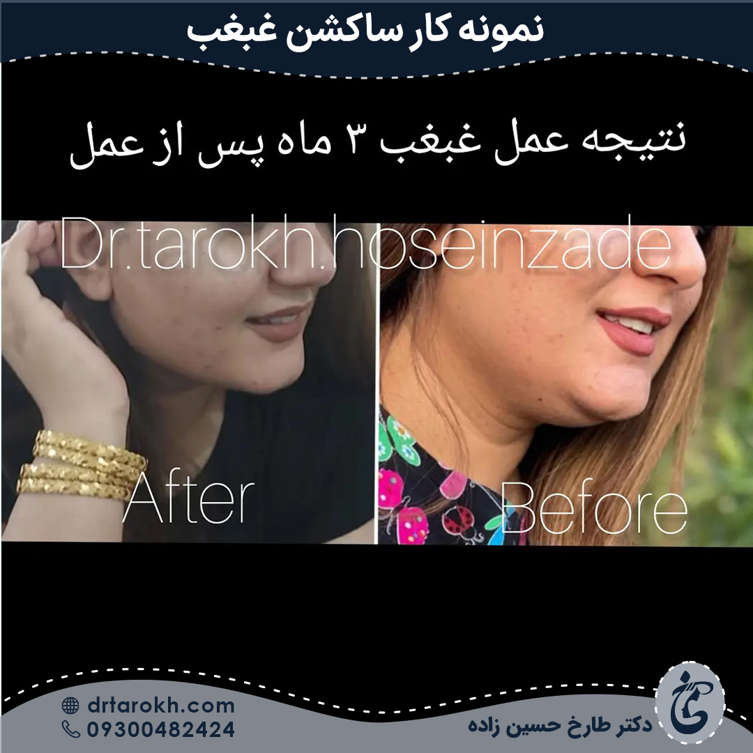 سه ماه بعد از ساکشن غبغب در شیراز