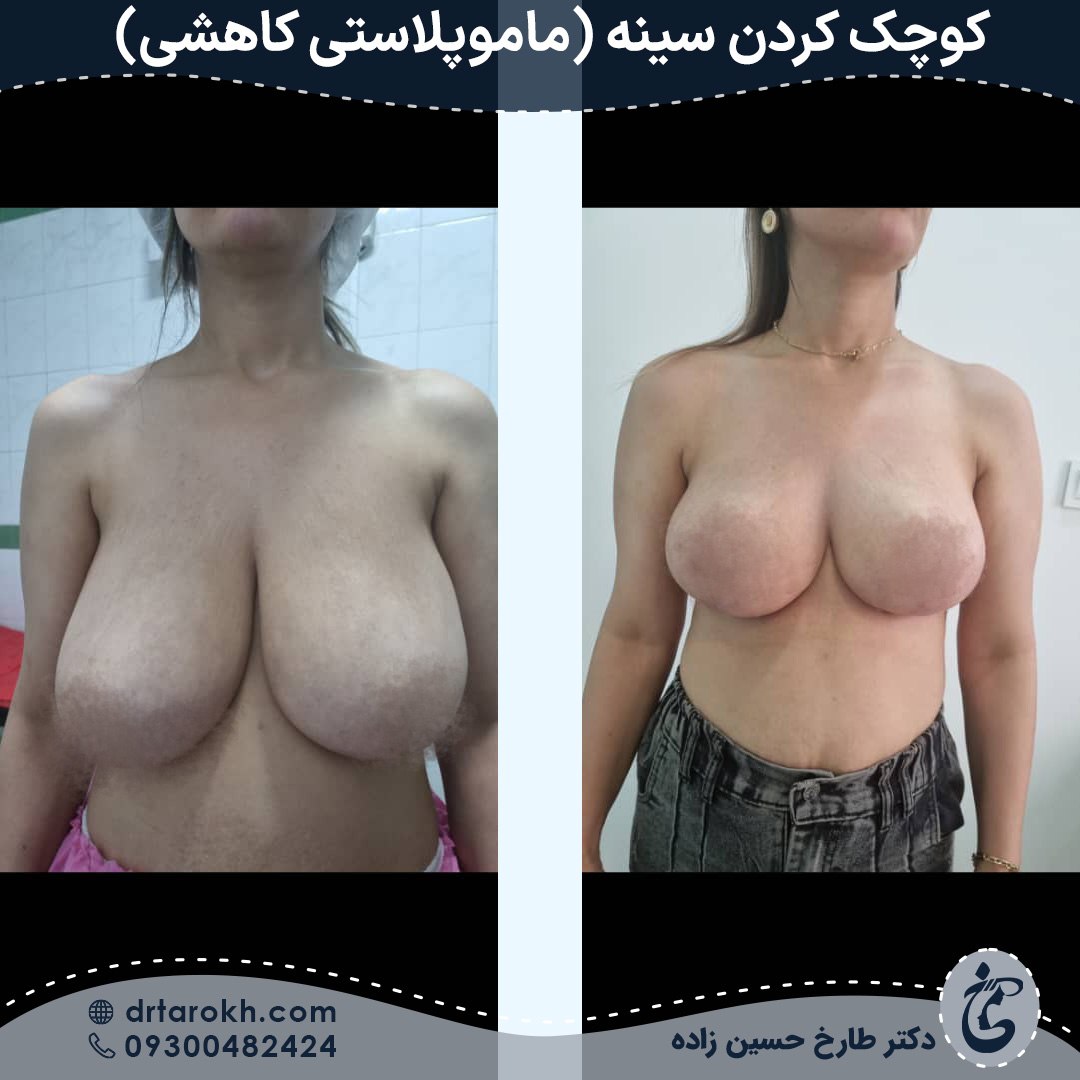 نمونه کار کوچک کردن سینه در شیراز