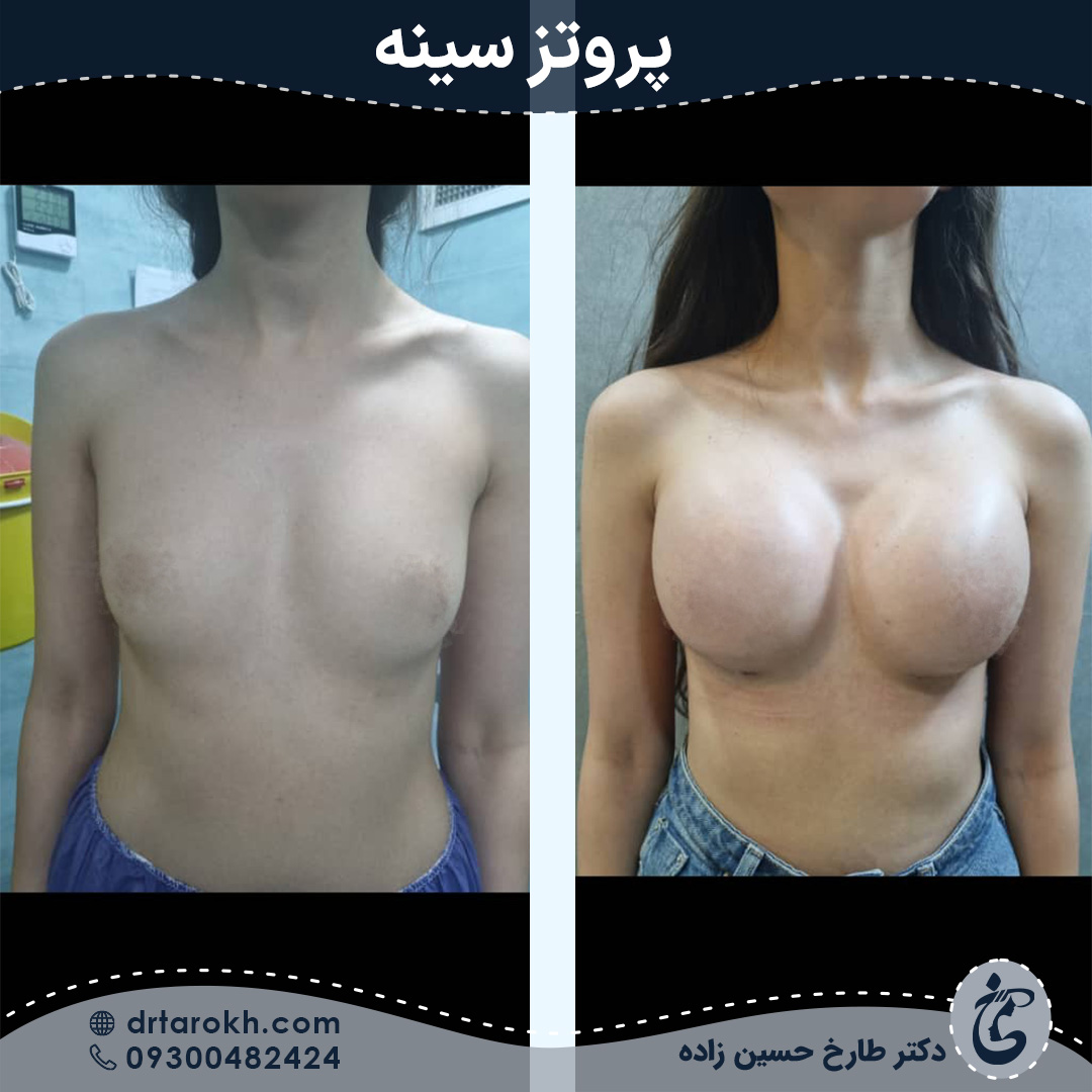 قبل و بعد پروتز سینه در شیراز