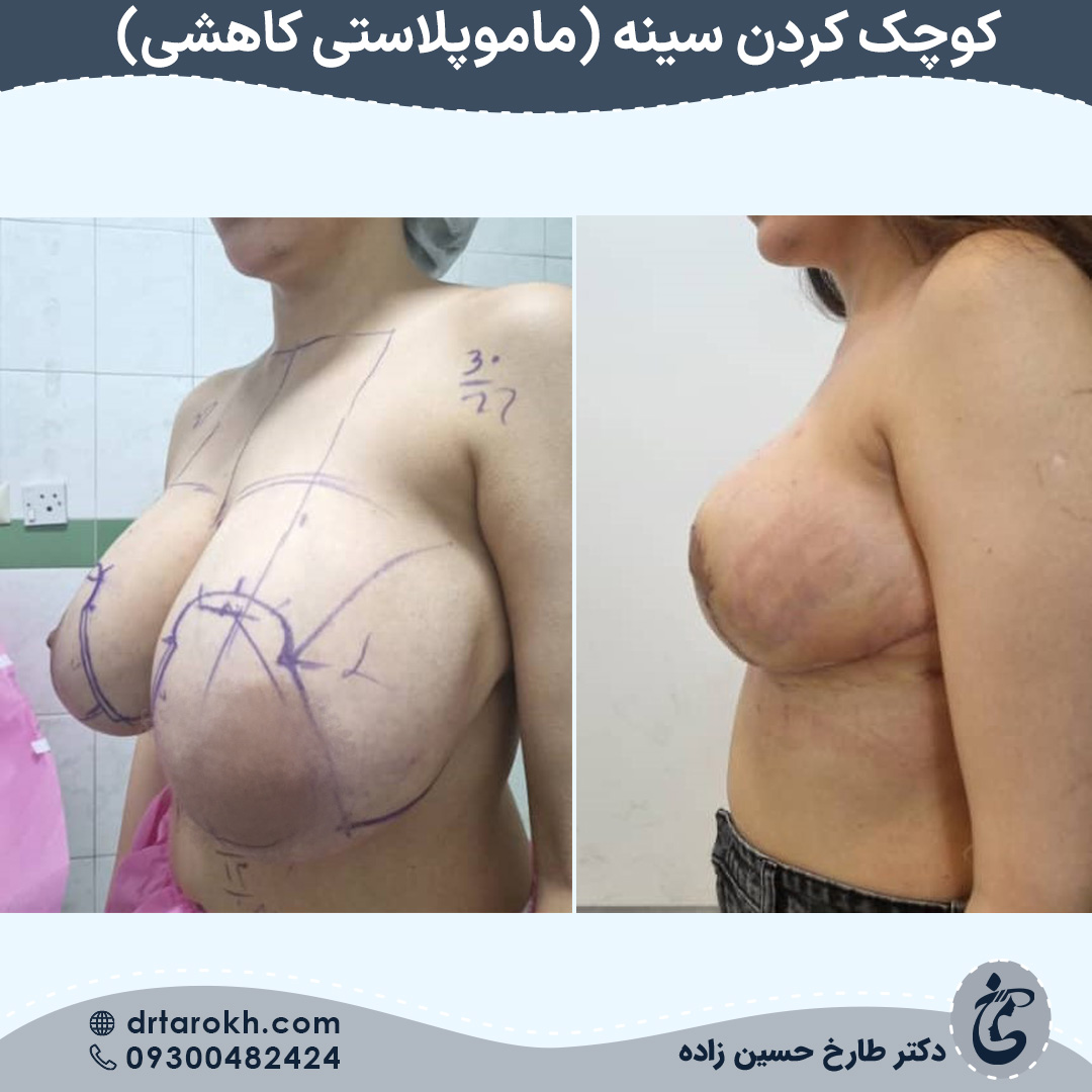 نمونه کار ماموپلاستی کاهشی در شیراز
