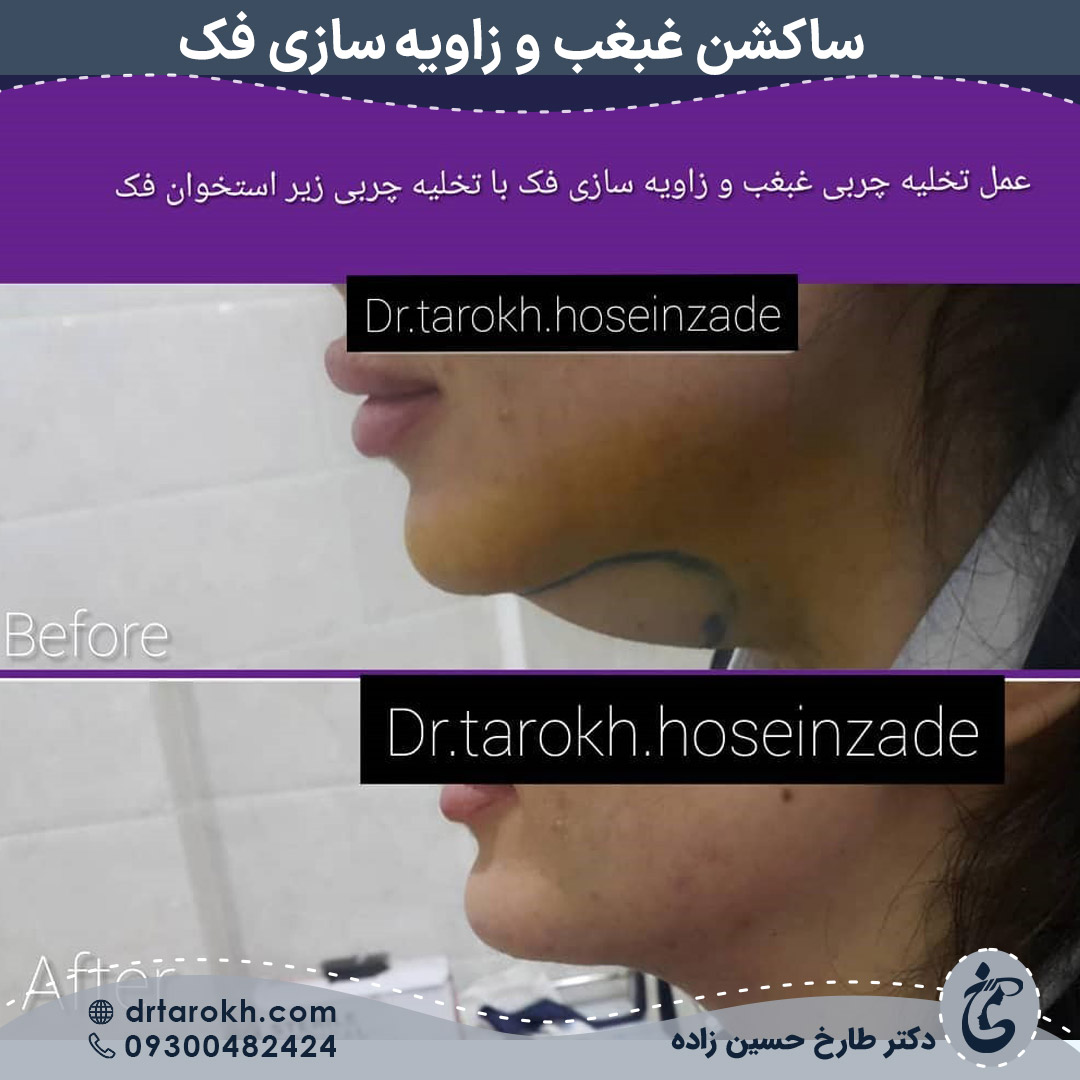 نمونه کار ساکشن غبغب توسط دکتر طارخ برای افراد چاق