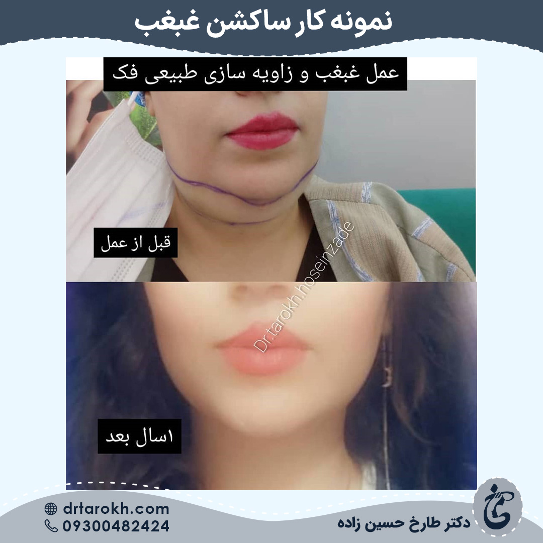 یک سال بعد از عمل غبغب