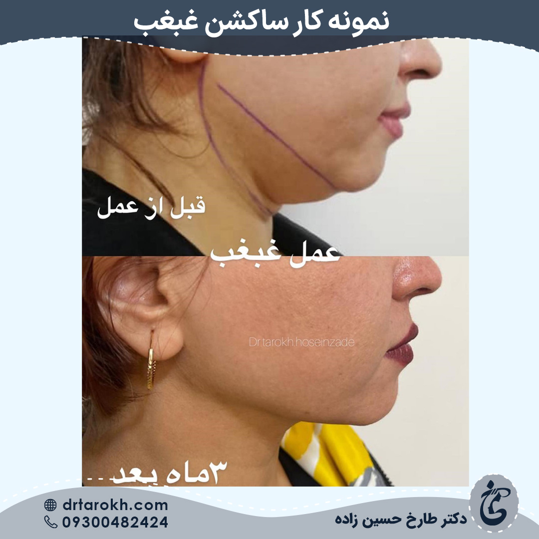 قبل و بعد ساکشن غبغب