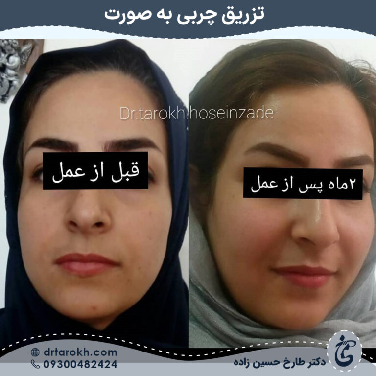 نمونه کار تزریق چربی به صورت توسط دکتر طارخ حسین زاده نمونه کار تزریق چربی به صورت توسط دکتر طارخ حسین زاده