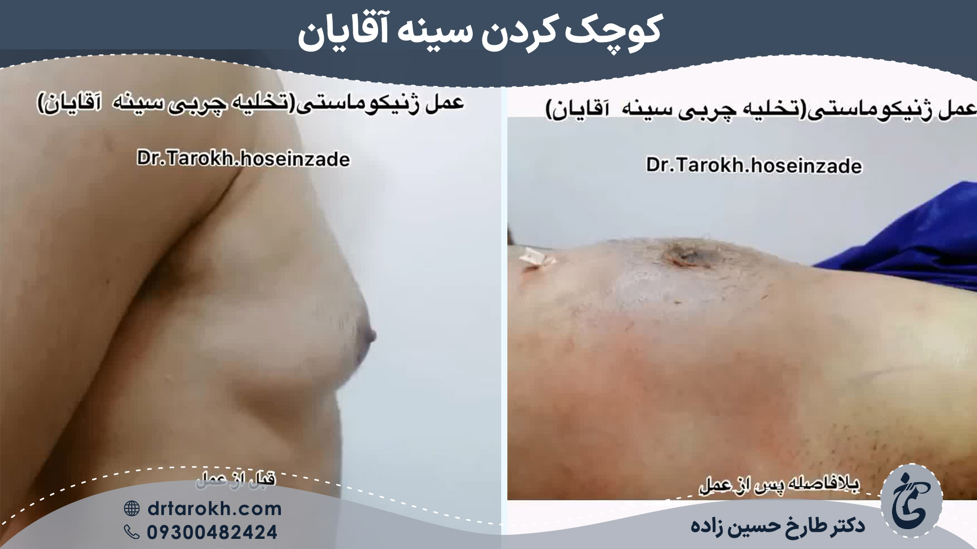 نمونه کار کوچک کردن سینه آقایان یا ژنیکوماستی توسط دکتر طارخ حسین زاده نمونه کار کوچک کردن سینه آقایان یا ژنیکوماستی توسط دکتر طارخ حسین زاده