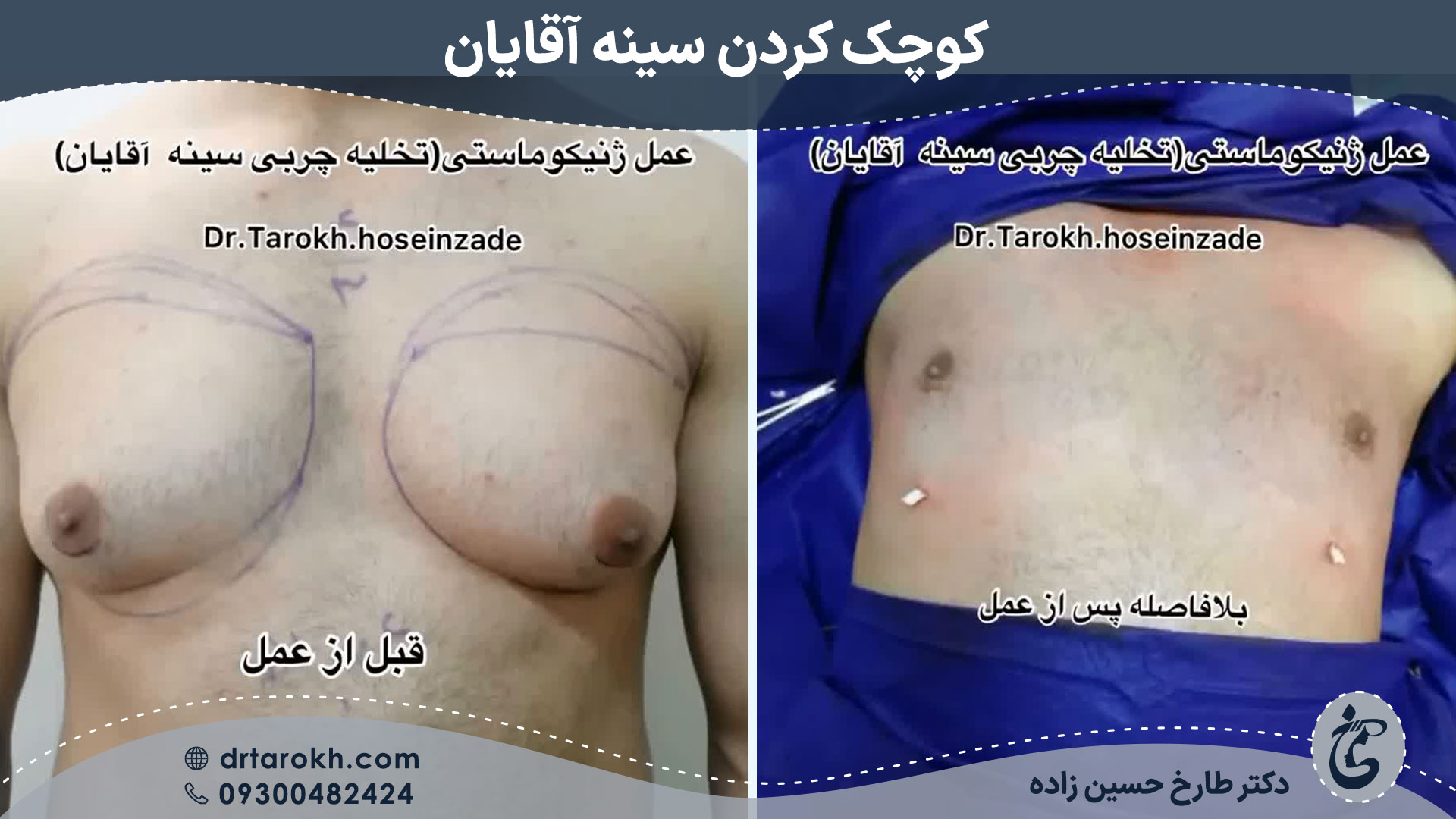 نمونه کار کوچک کردن سینه آقایان یا ژنیکوماستی در شیراز توسط دکتر طارخ حسین زاده نمونه کار کوچک کردن سینه آقایان یا ژنیکوماستی در شیراز توسط دکتر طارخ حسین زاده