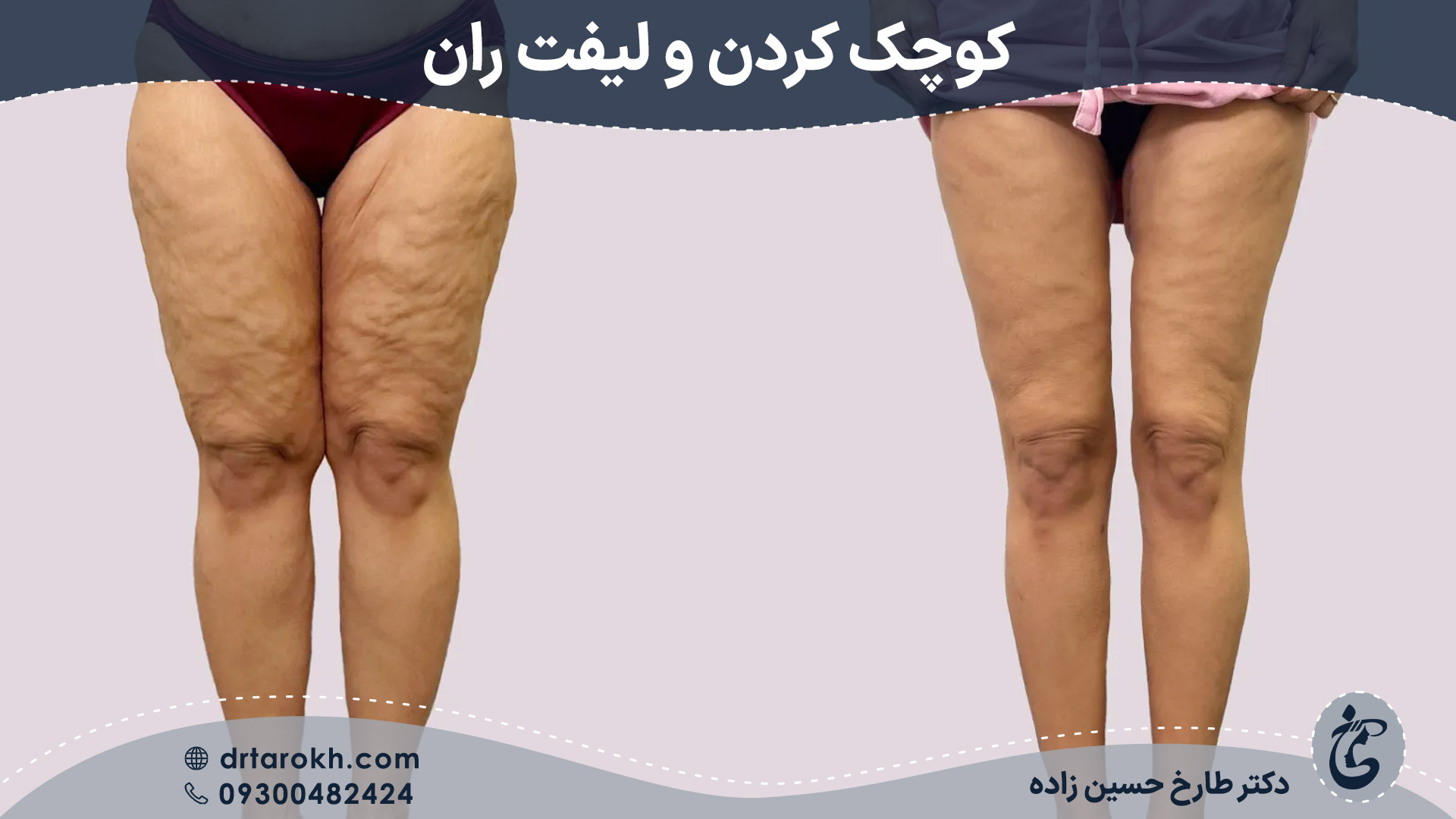 قبل و بعد لیفت ران