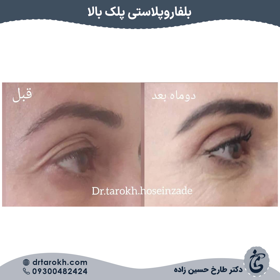 عمل بلفاروپلاستی در شیراز