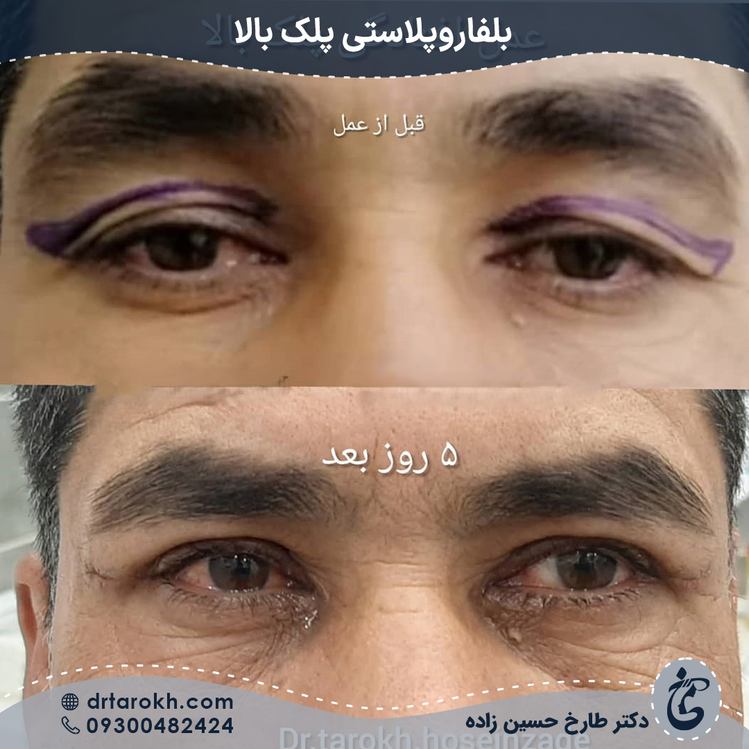 بلفاروپلاستی پلک بالا برای آقایان
