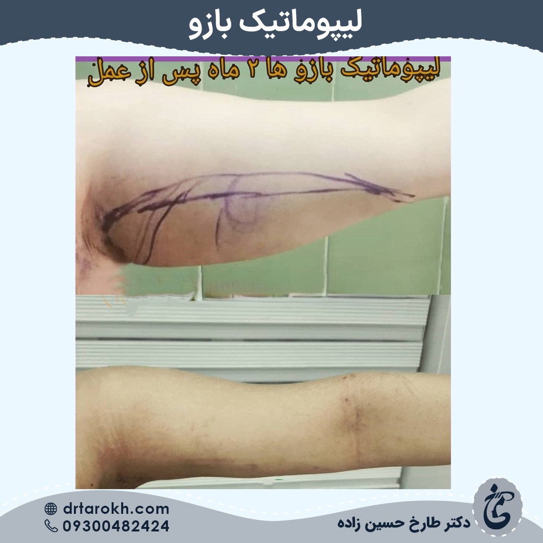 دو ماه بعد از لیپوماتیک بازو در شیراز دو ماه بعد از لیپوماتیک بازو در شیراز