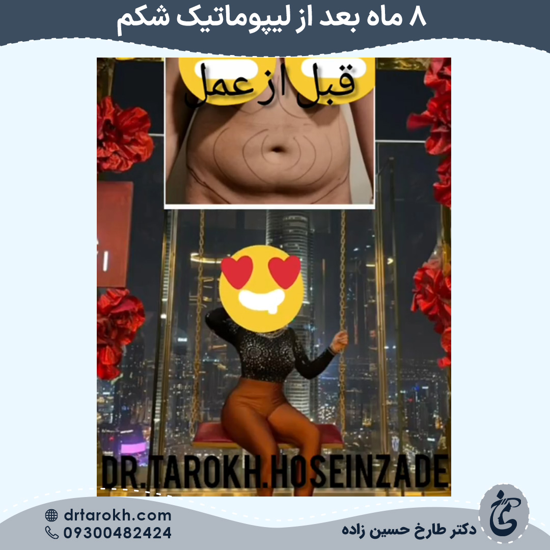 هشت ماه بعد از لیپوماتیک شکم در شیراز
