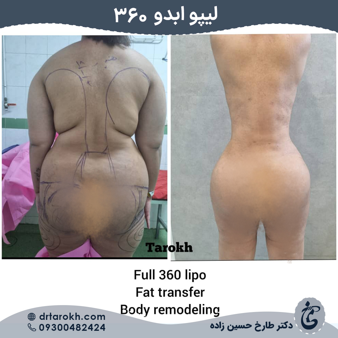 لیپو ابدو 360 در شیراز