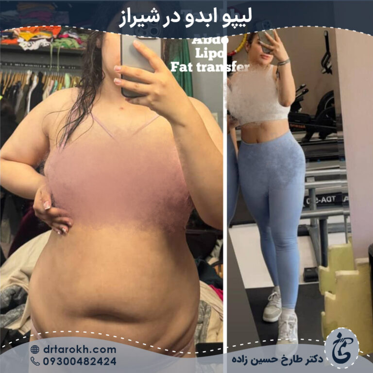 عمل لیپو ابدو در شیراز عمل لیپو ابدو در شیراز