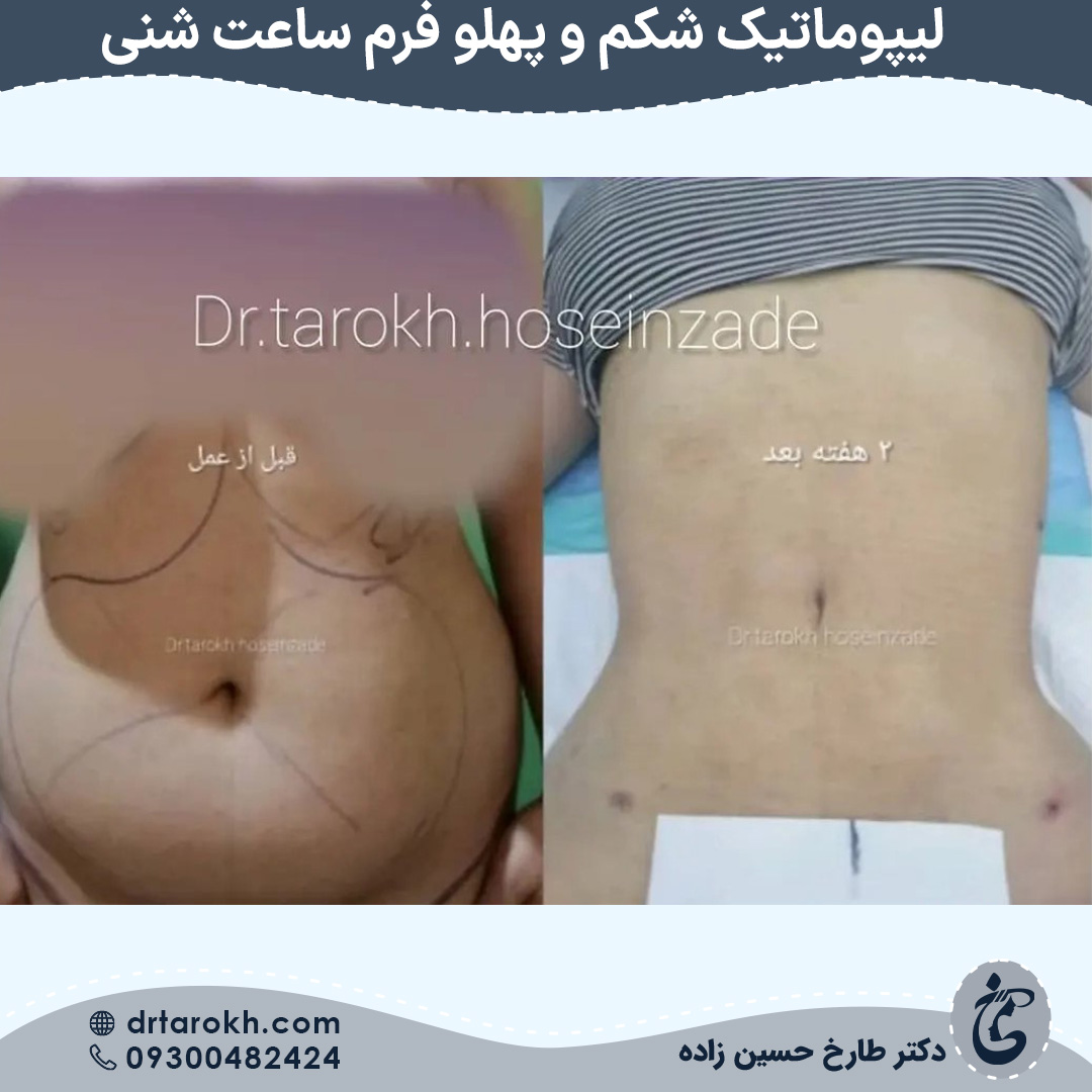 لیپوماتیک شکم و پهلو فرم ساعت شنی در شیراز