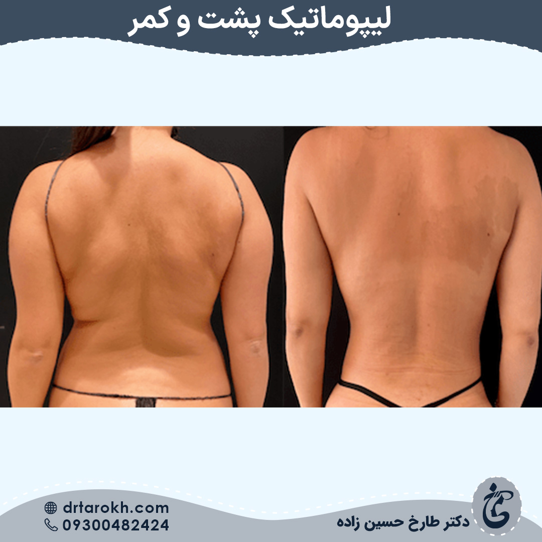 لیپوماتیک کمر در شیراز
