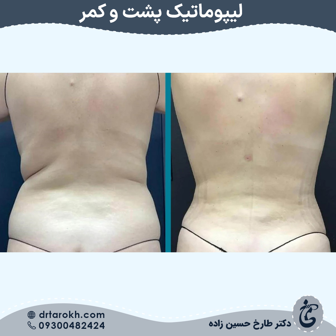 لیپوماتیک پشت و کمر در شیراز