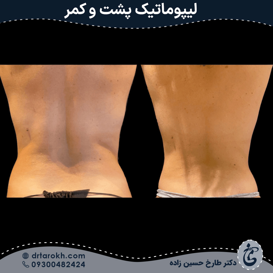 لیپوماتیک پشت در شیراز