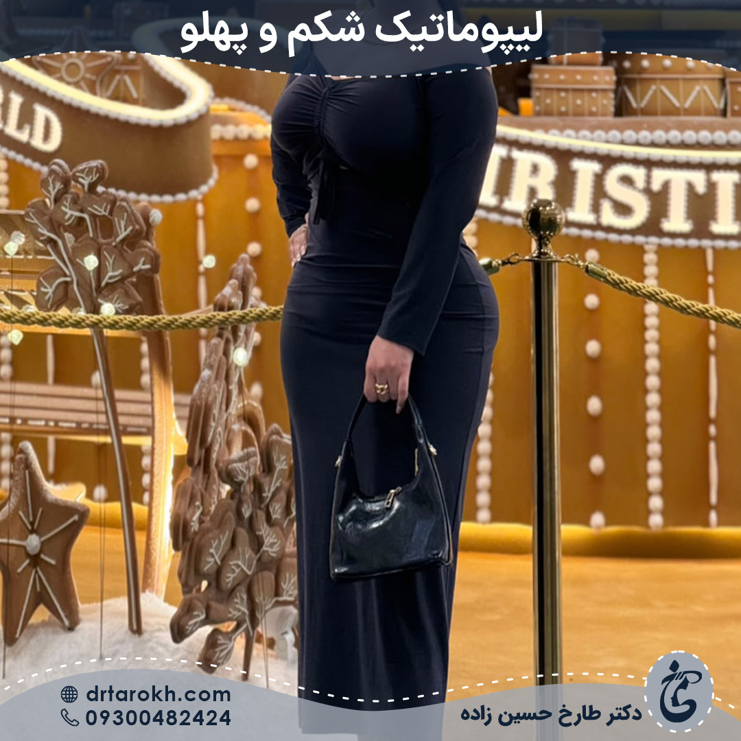 بعد از لیپوماتیک شکم و پهلو در شیراز