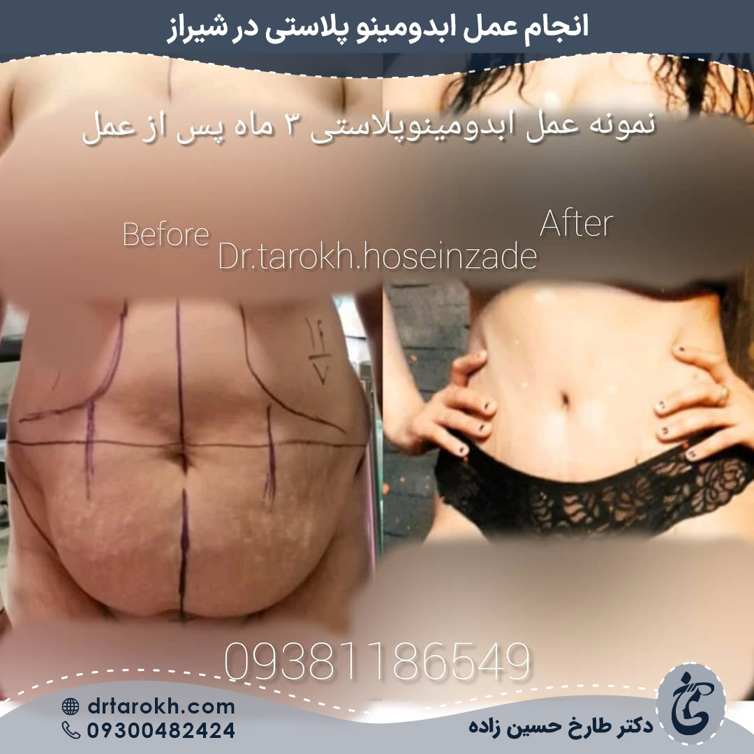 قبل و بعد ابدومینوپلاستی شیراز قبل و بعد ابدومینوپلاستی شیراز