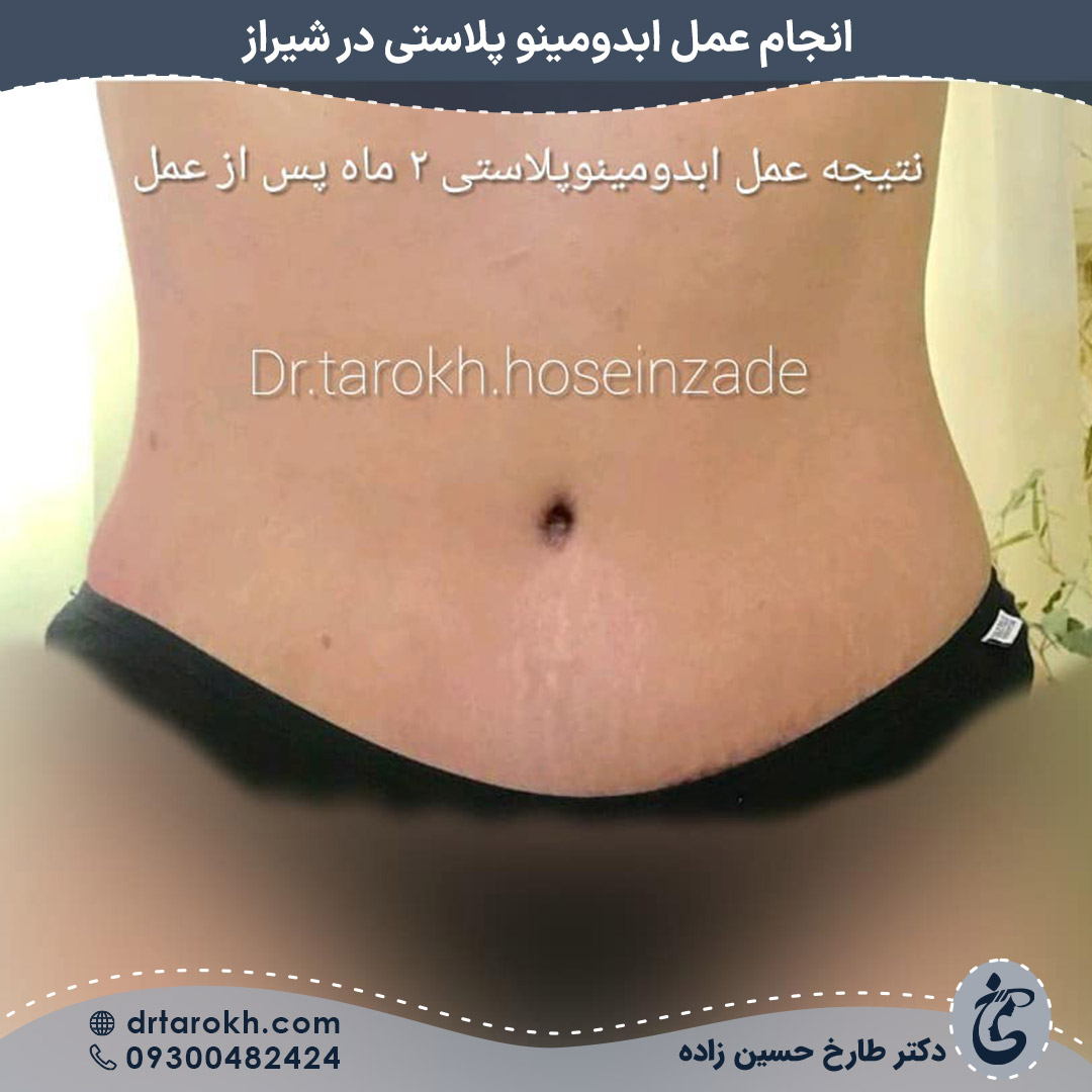 عمل ابدومینوپلاستی در شیراز