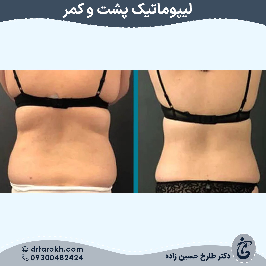 قبل و بعد لیپوماتیک پشت و کمر در شیراز