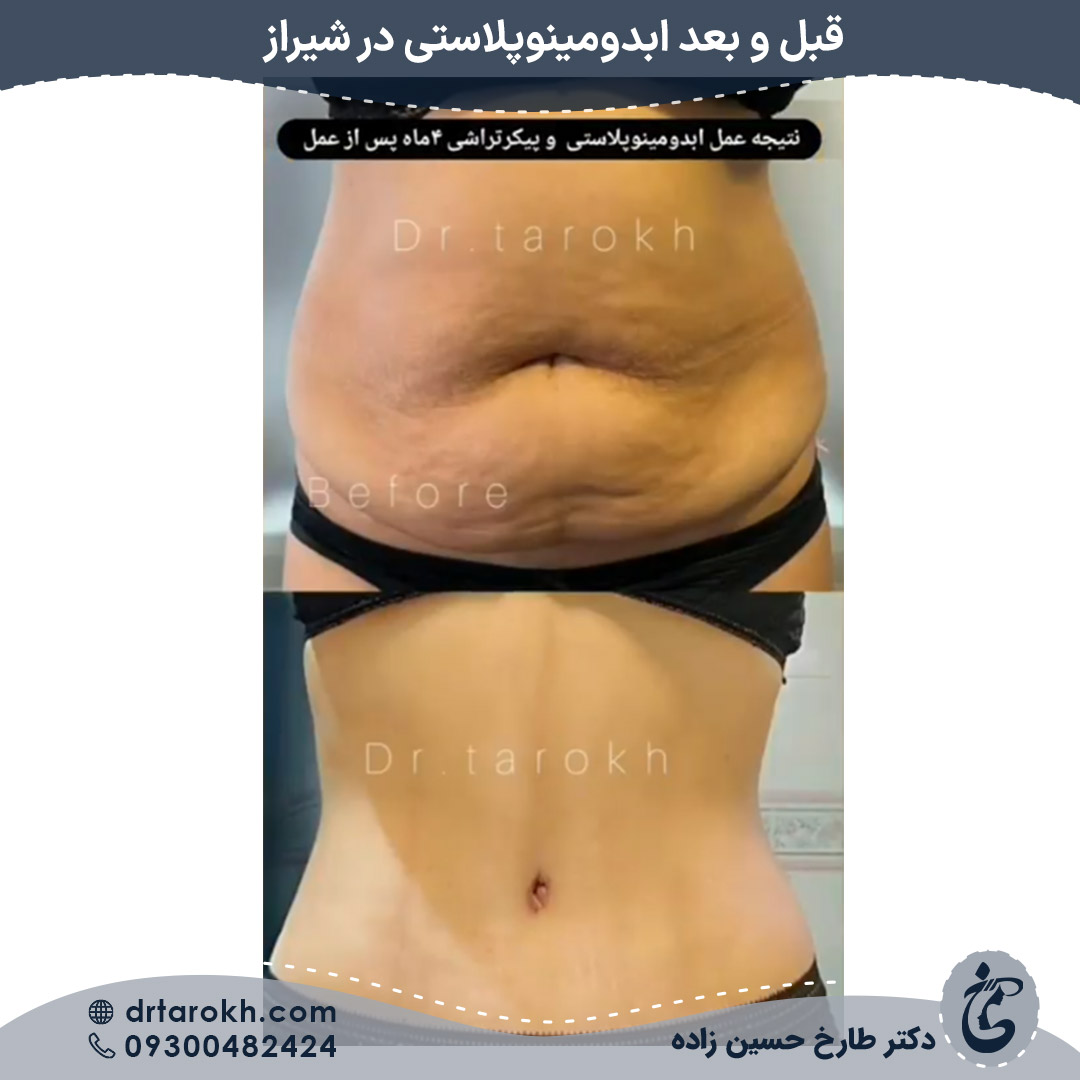 عمل ابدومینوپلاستی شیراز عمل ابدومینوپلاستی شیراز