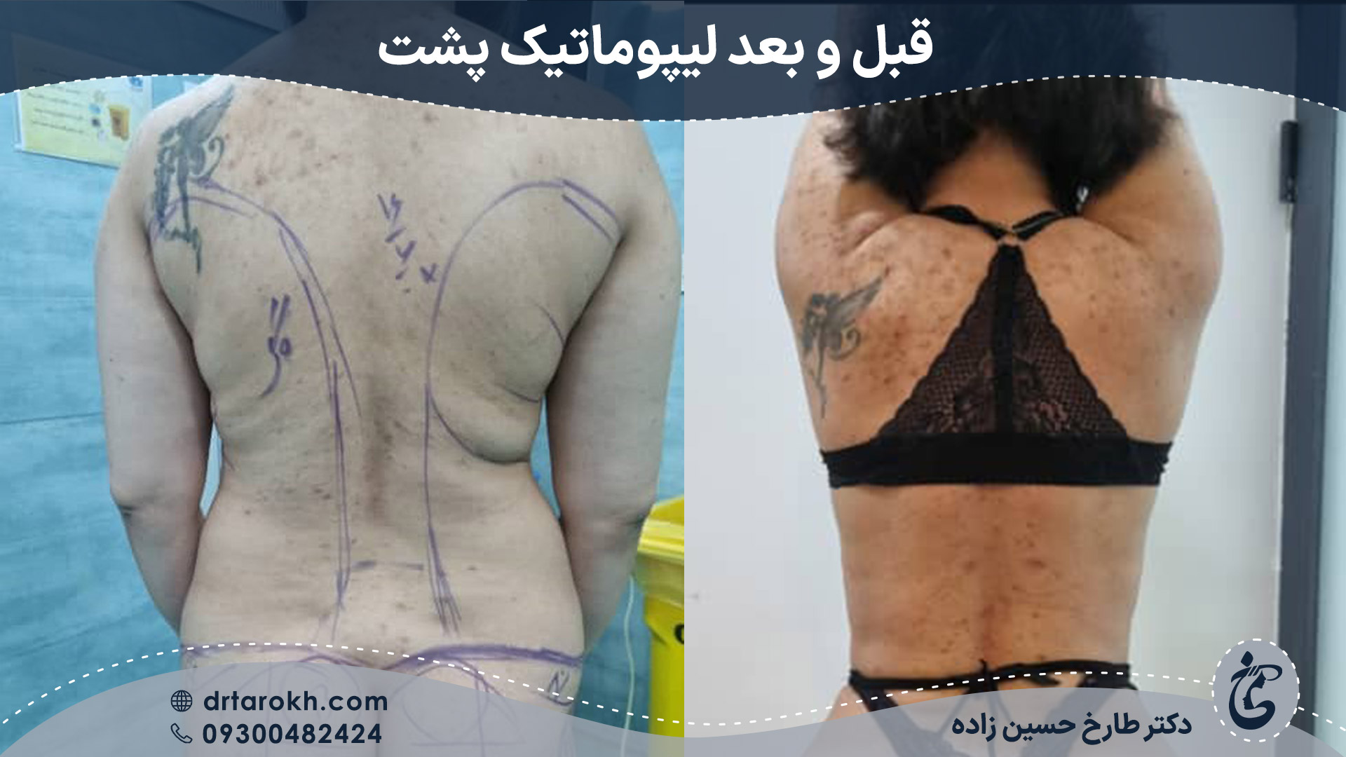 قبل و بعد لیپوماتیک پشت و کمر در شیراز توسط دکتر طارخ حسین زاده