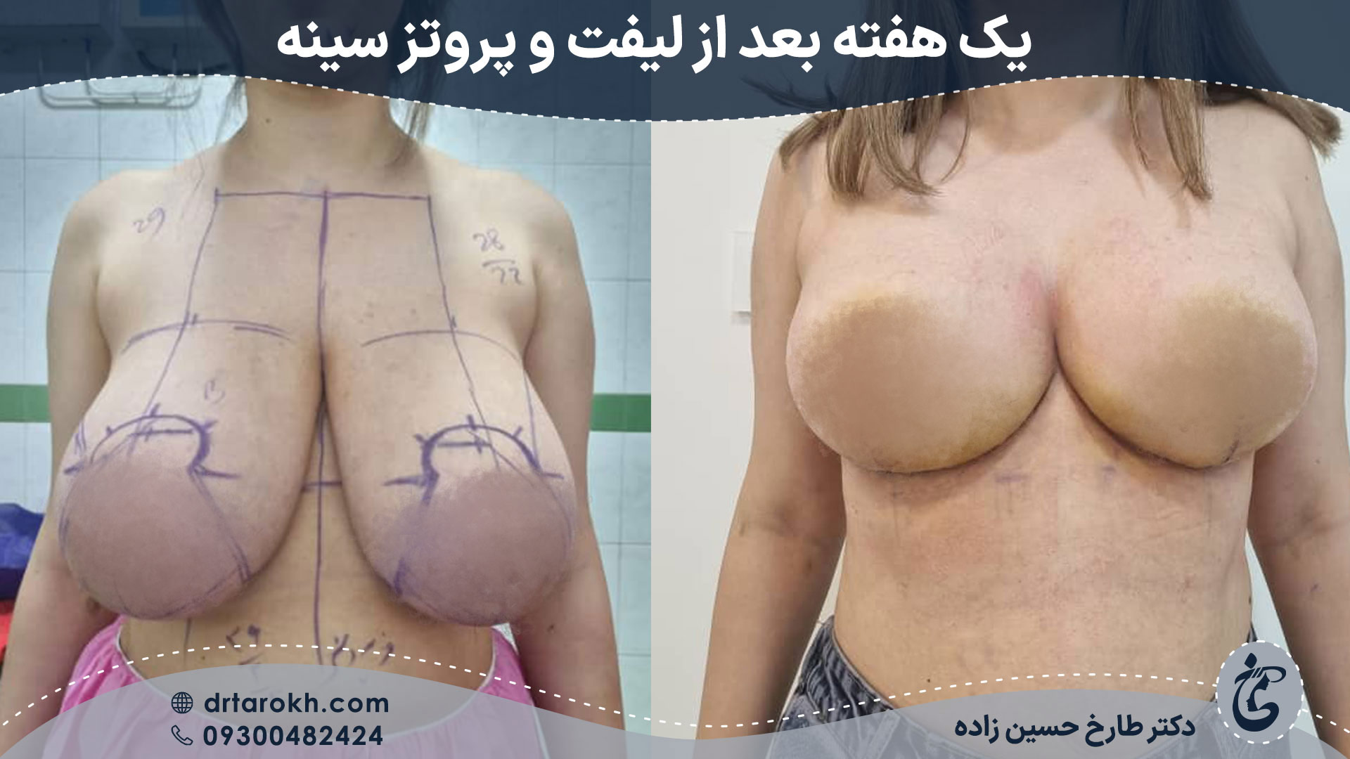 یک هفته بعد از لیفت و پروتز سینه توسط دکتر طارخ حسین زاده