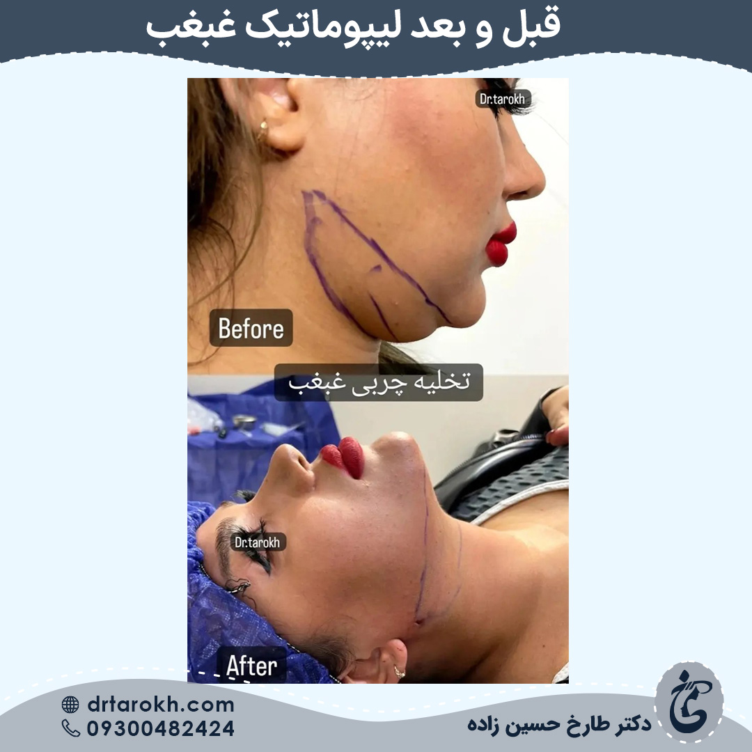 قبل و بعد لیپوماتیک غبغب توسط دکتر تارخ در شیراز