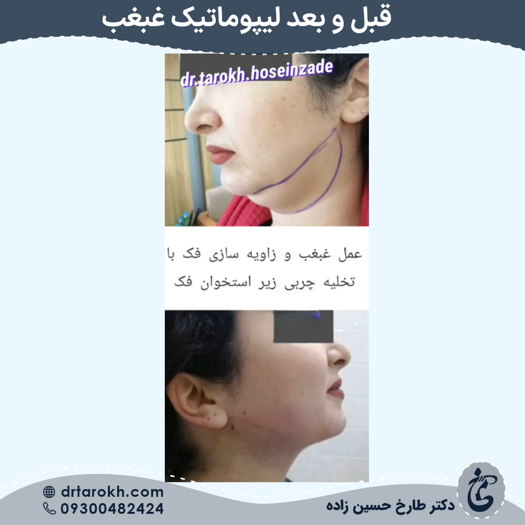 قبل و بعد لیپوماتیک غبغب در شیراز