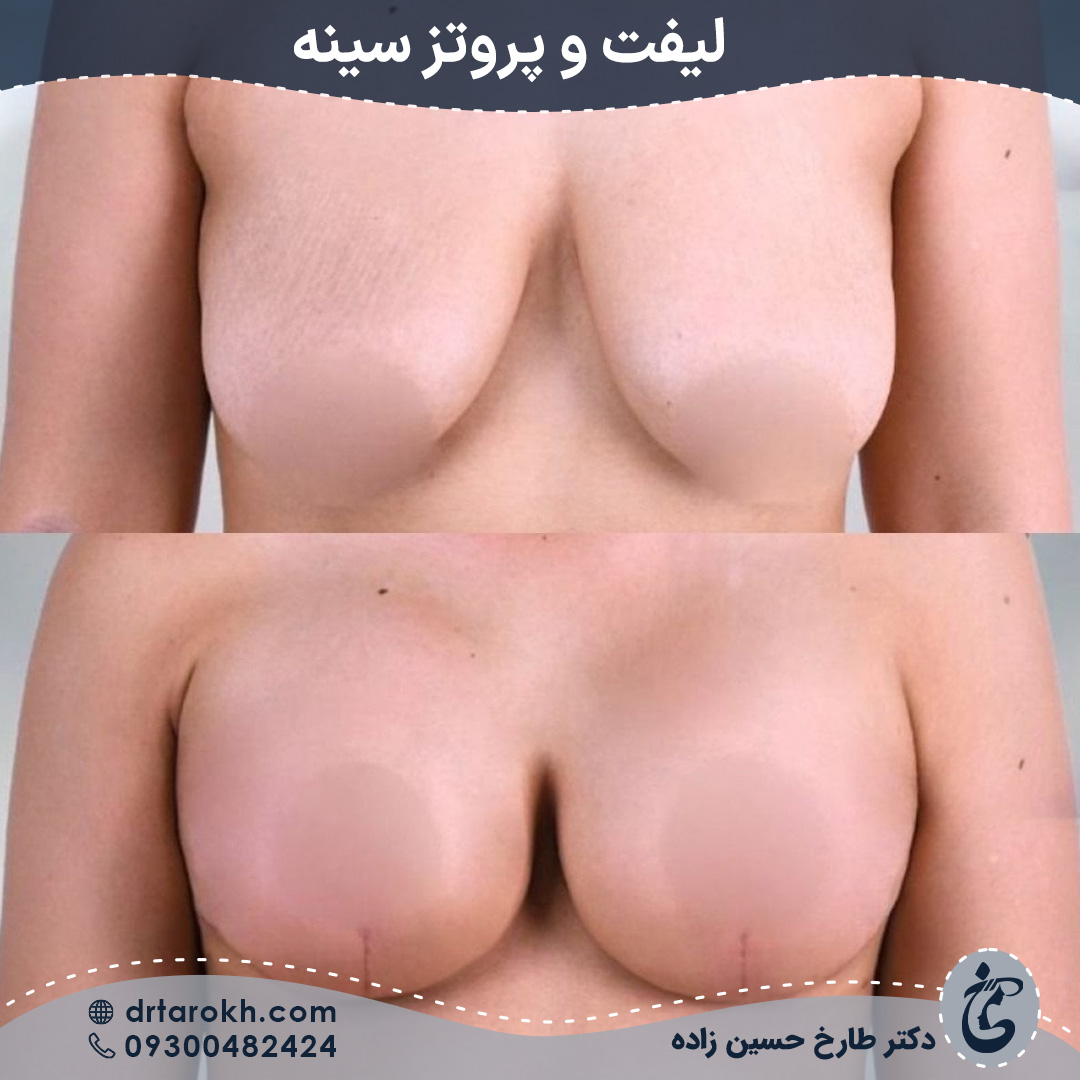 لیفت و پروتز سینه در شیراز