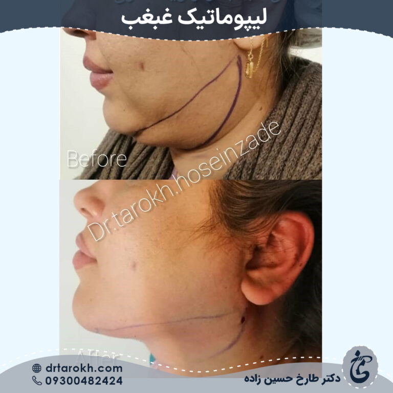 لیپوماتیک غبغب شیراز