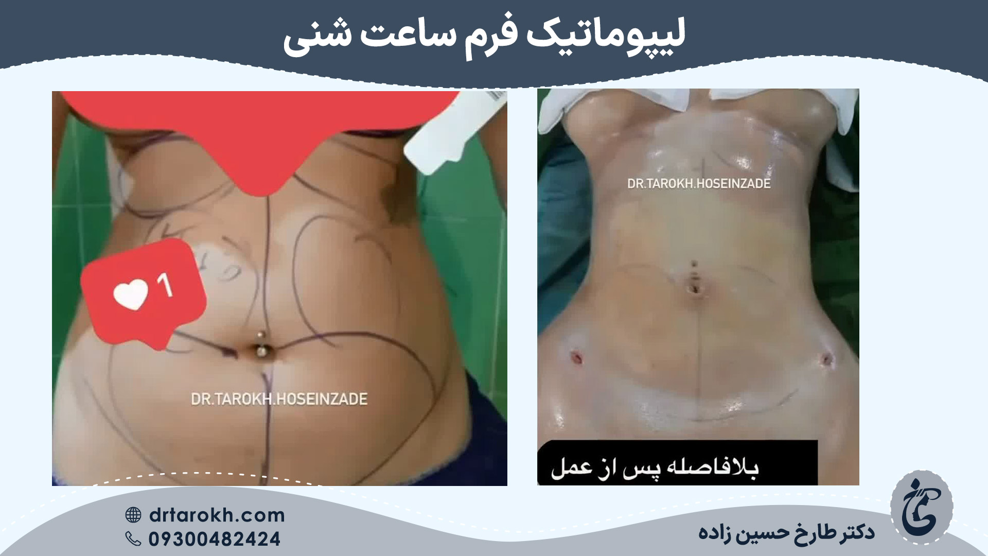 نمونه کار لیپوماتیک فرم ساعت شنی توسط دکتر طارخ حسین زاده